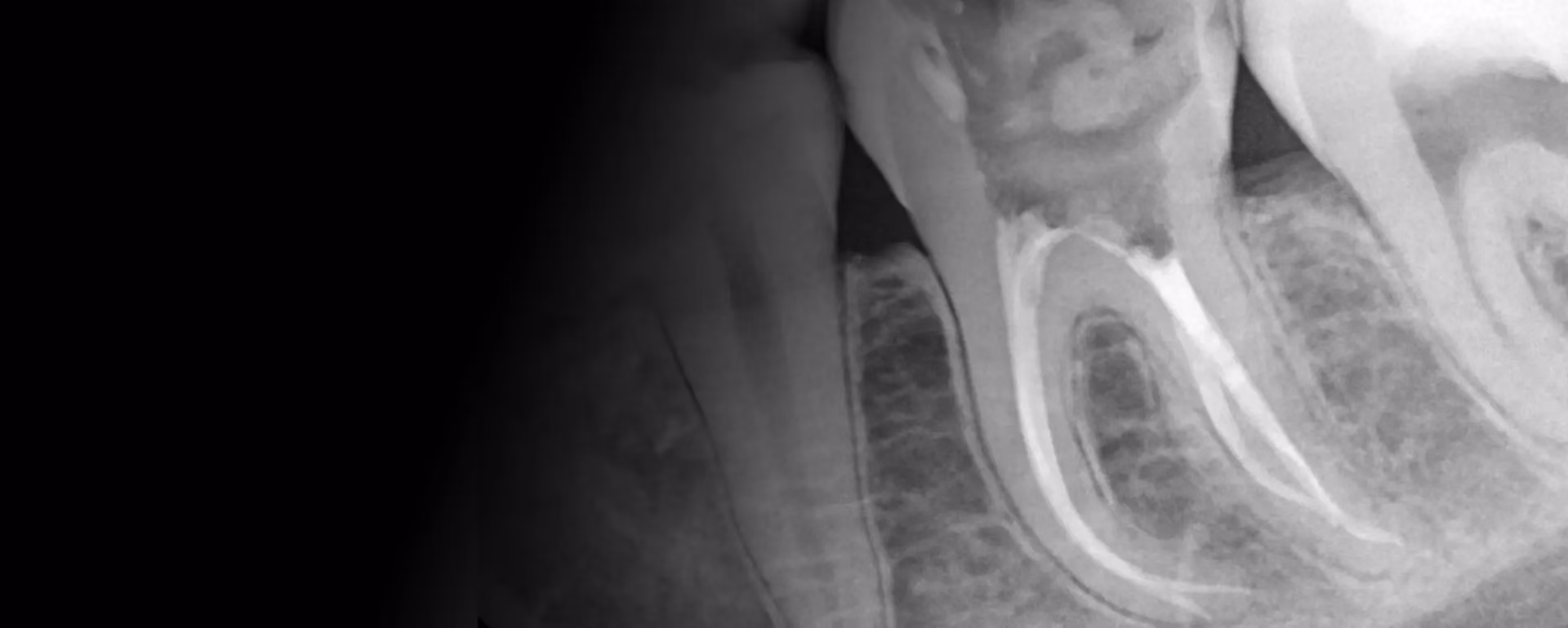 How much does root canal treatment cost? A full breakdown