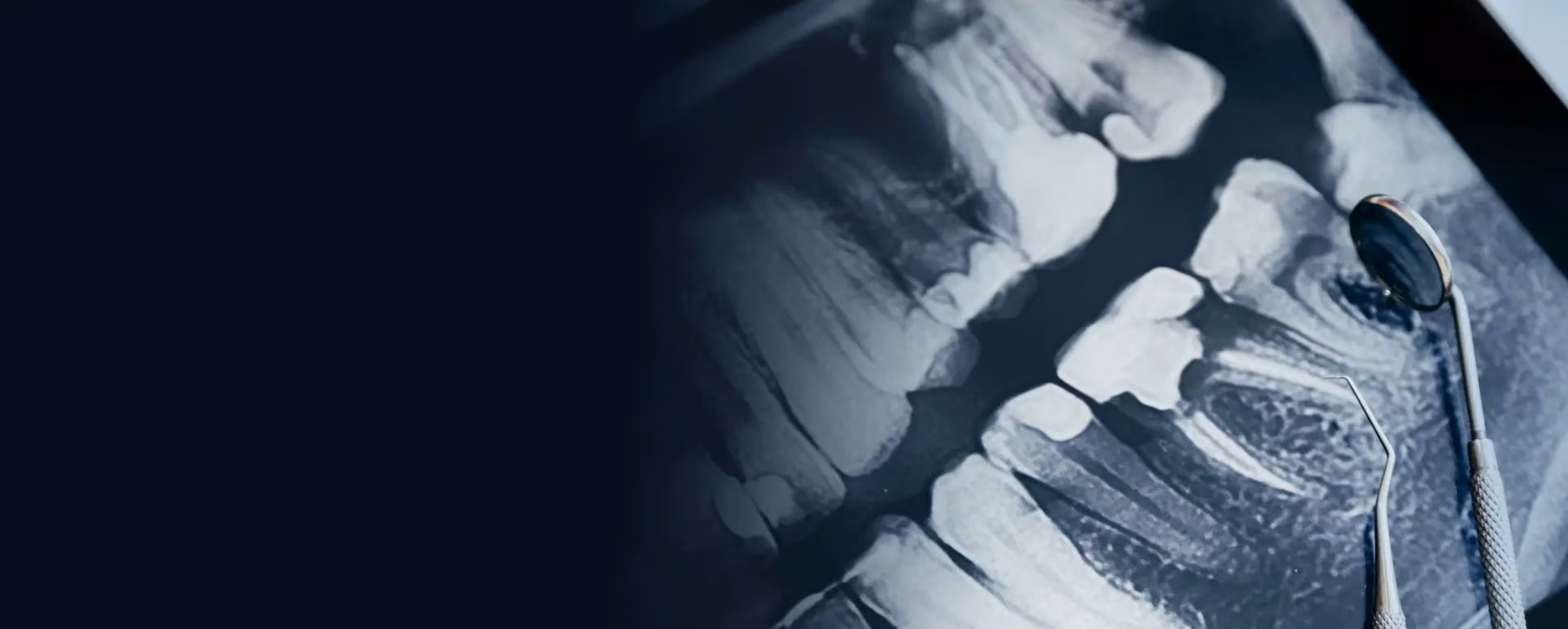 Can the bone around a tooth shrink after root canal treatment?