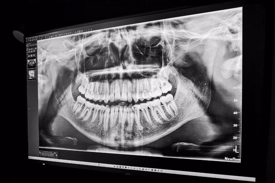 An X-ray of the jaw on a monitor An X-ray of the jaw on a monitor