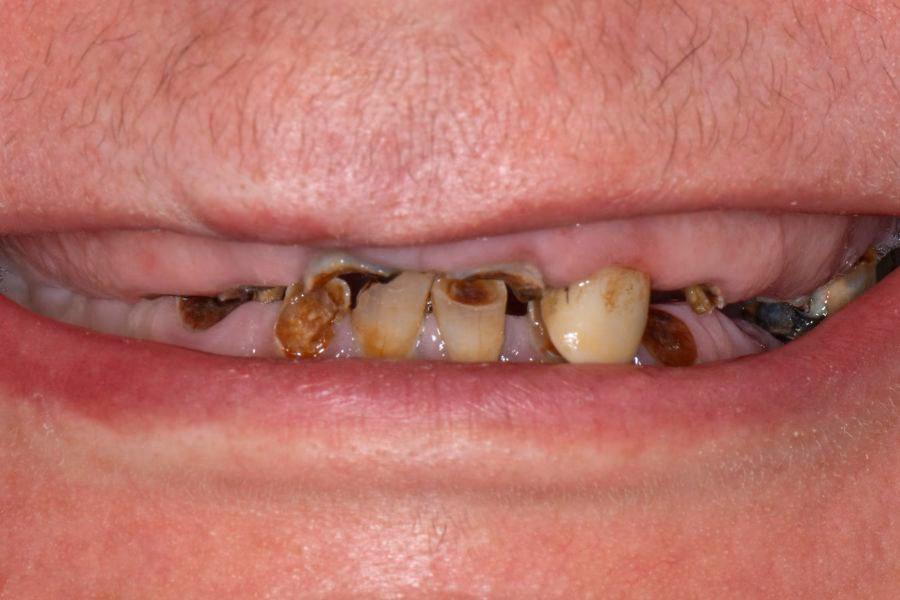 Before dental restoration