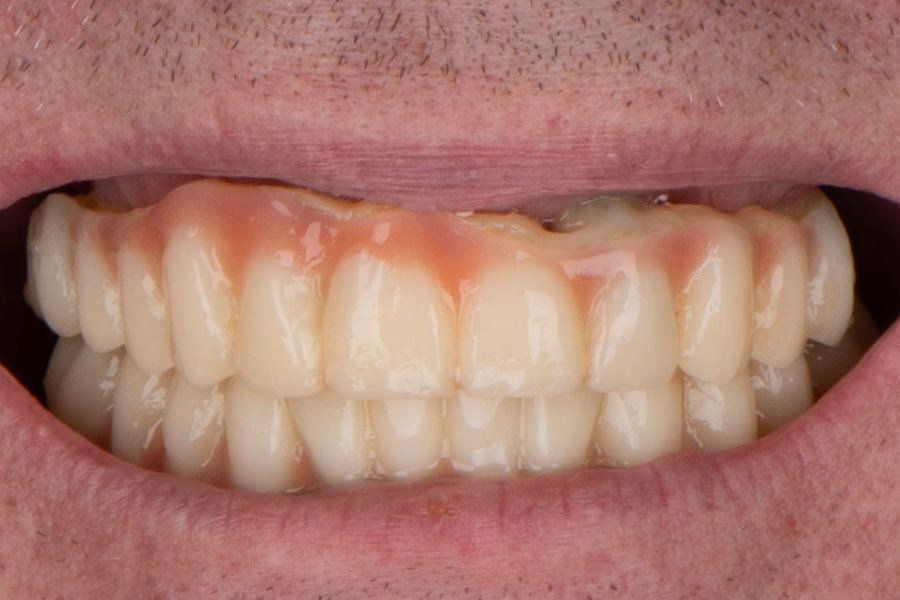 Before & after – Flow Dental Studio Gdynia