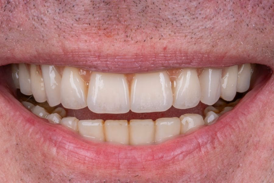 Smile makeover before and after treatment - Flow Dental Studio Gdynia