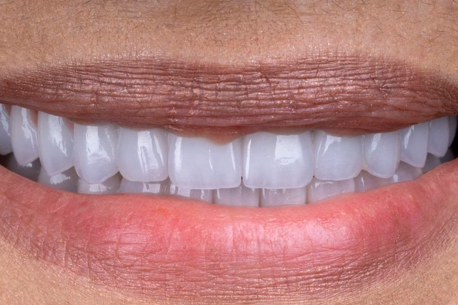 Smile before and after a fixed full-arch restoration - Flow Dental Studio Gdynia