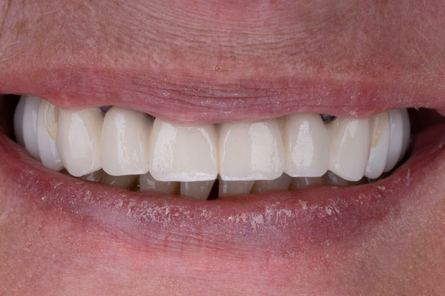 Before & after – Flow Dental Studio Gdynia