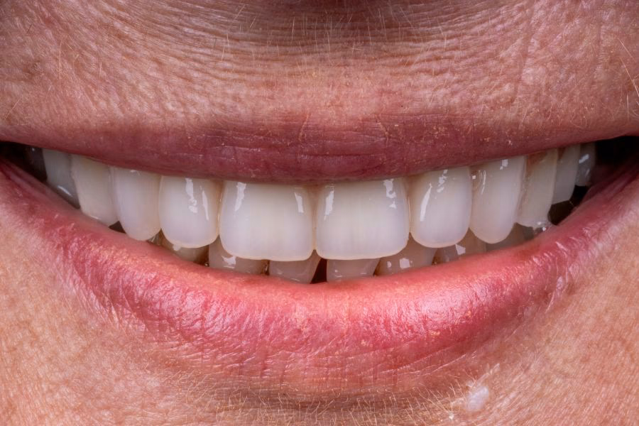 Smile makeover before and after treatment - Flow Dental Studio Gdynia
