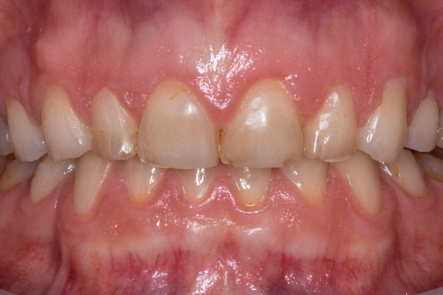 Before & after – Flow Dental Studio Gdynia