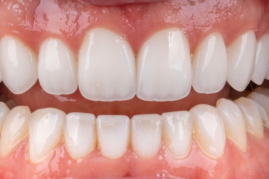 Smile makeover before and after treatment - Flow Dental Studio Gdynia