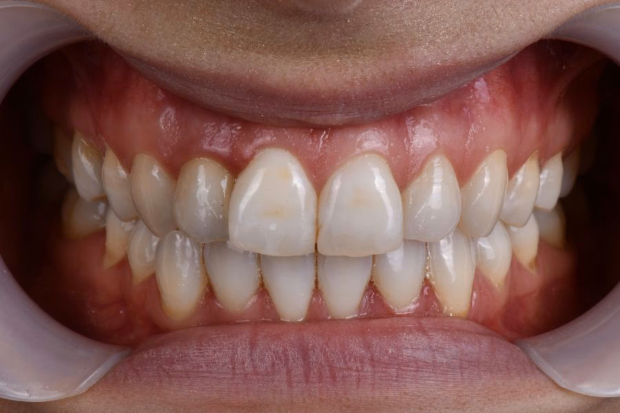 Before & after – Flow Dental Studio Gdynia