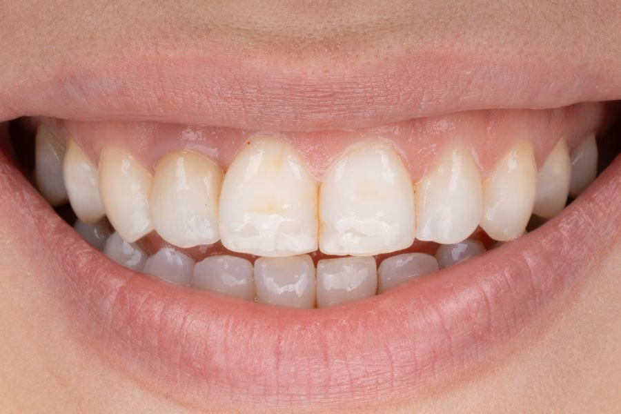 Smile makeover before and after treatment - Flow Dental Studio Gdynia