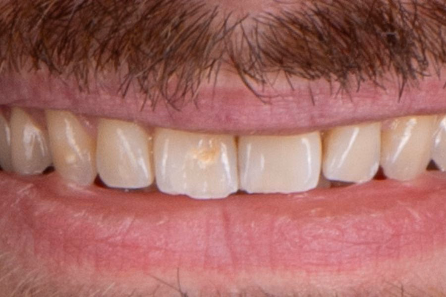 Before & after – Flow Dental Studio Gdynia