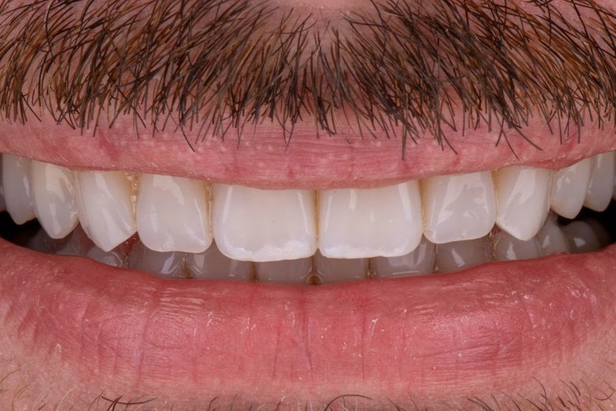 Smile makeover before and after treatment - Flow Dental Studio Gdynia