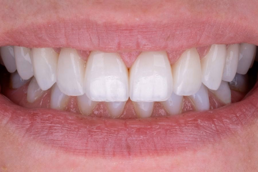 Smile makeover before and after treatment - Flow Dental Studio Gdynia