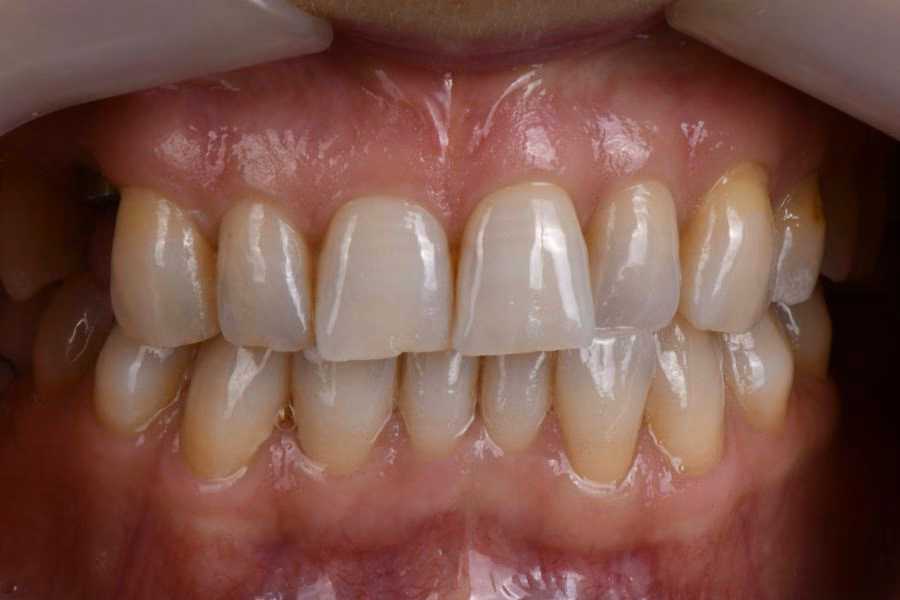 Before & after – Flow Dental Studio Gdynia