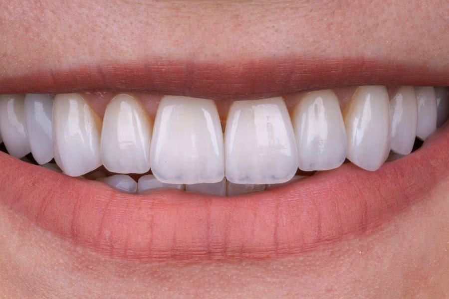 Smile makeover before and after treatment - Flow Dental Studio Gdynia