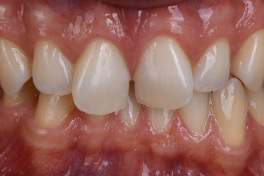 Before & after – Flow Dental Studio Gdynia
