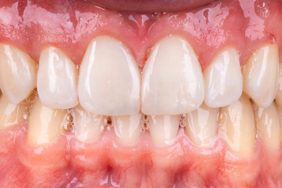 Smile makeover before and after treatment - Flow Dental Studio Gdynia