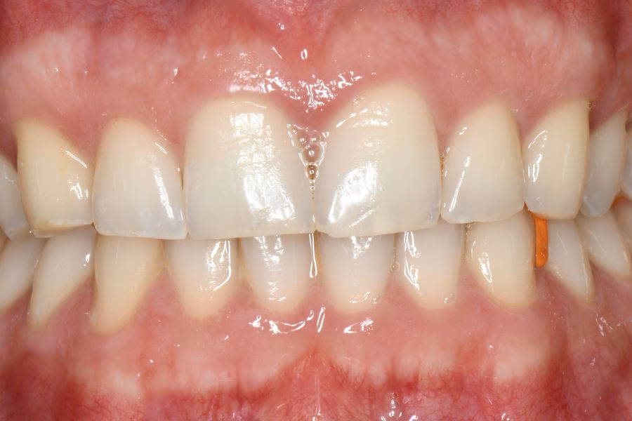 Before & after – Flow Dental Studio Gdynia