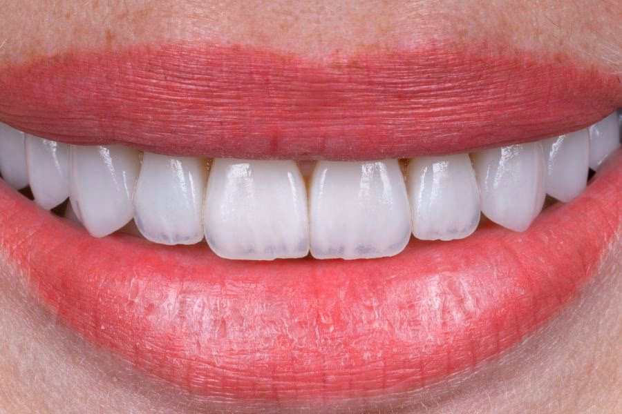 Smile makeover before and after treatment - Flow Dental Studio Gdynia