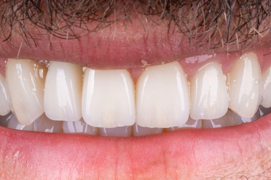 Smile before and after veneer treatment - Flow Dental Studio Gdynia