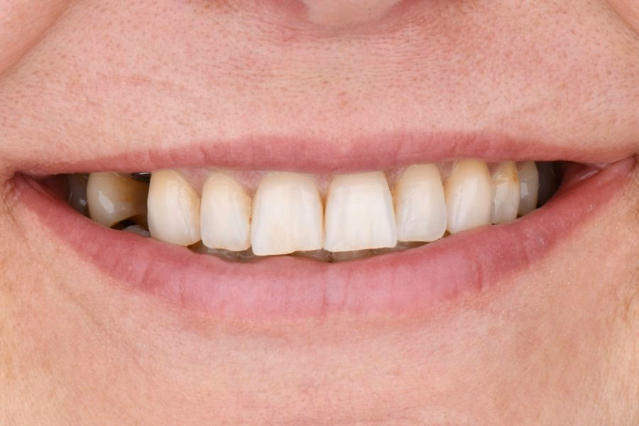 Before & after – Flow Dental Studio Gdynia