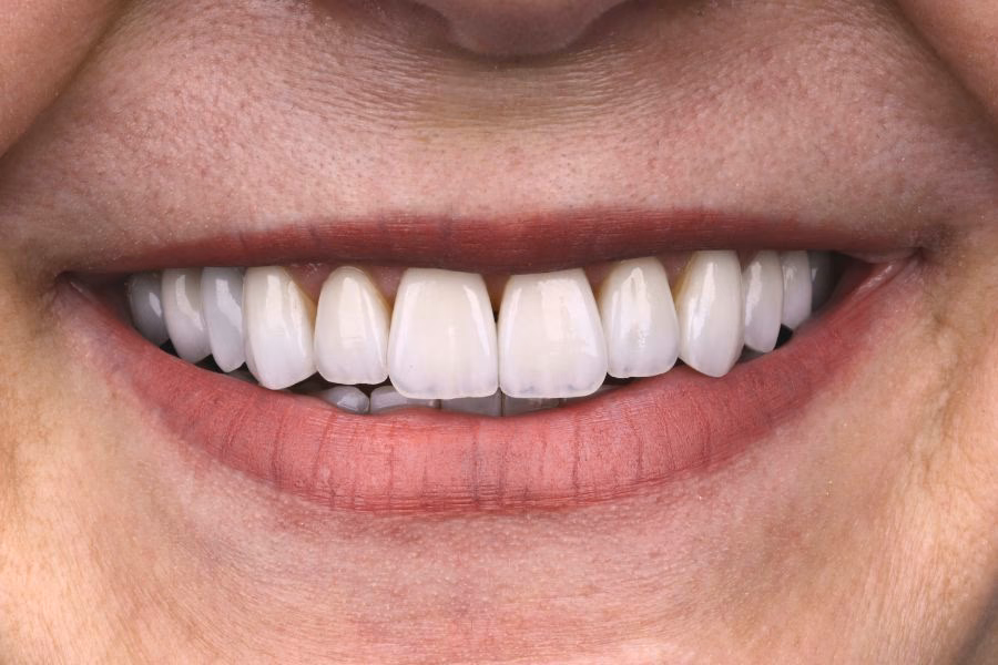 Smile makeover before and after treatment - Flow Dental Studio Gdynia