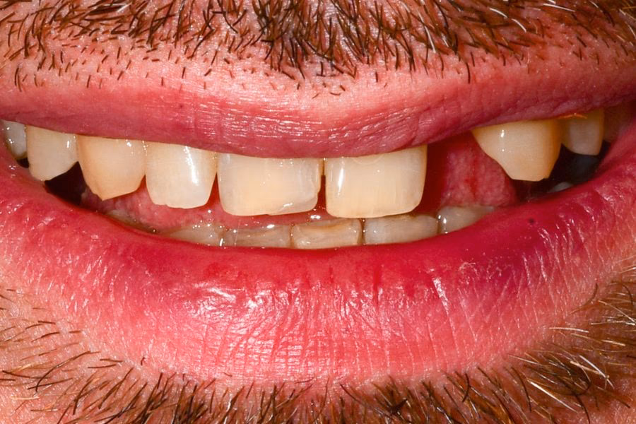 Before & after – Flow Dental Studio Gdynia