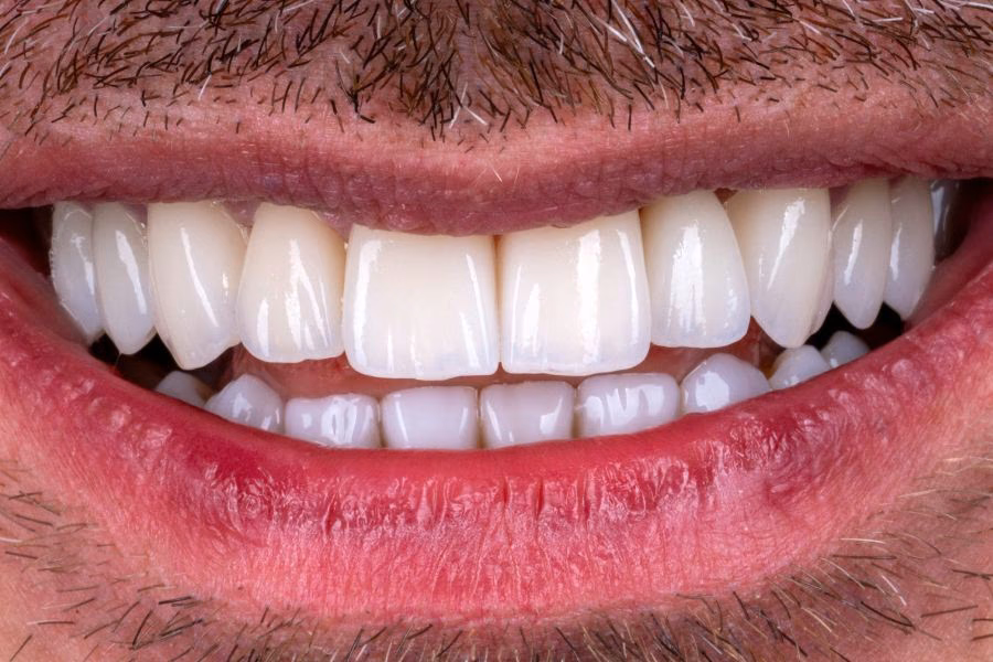 Smile makeover before and after treatment - Flow Dental Studio Gdynia