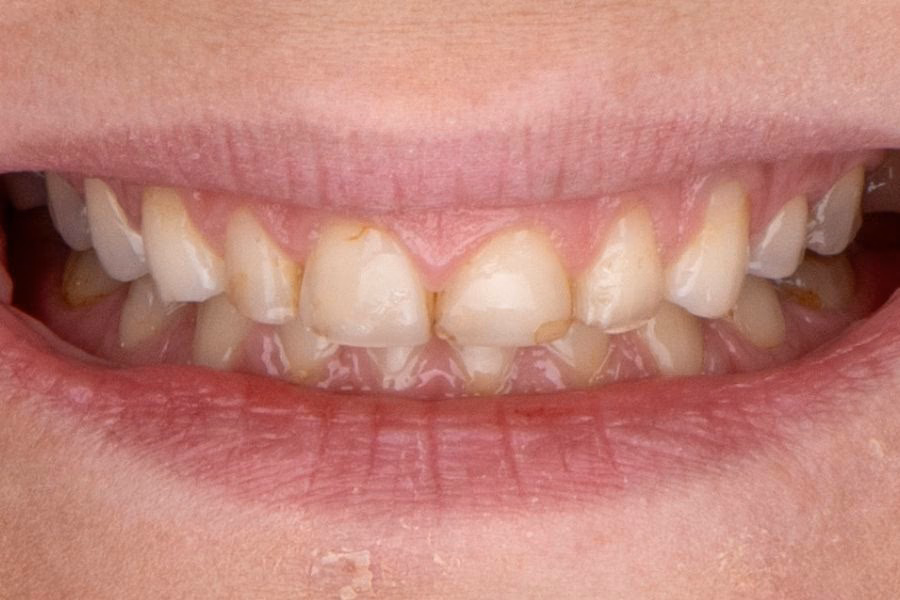 Before & after – Flow Dental Studio Gdynia