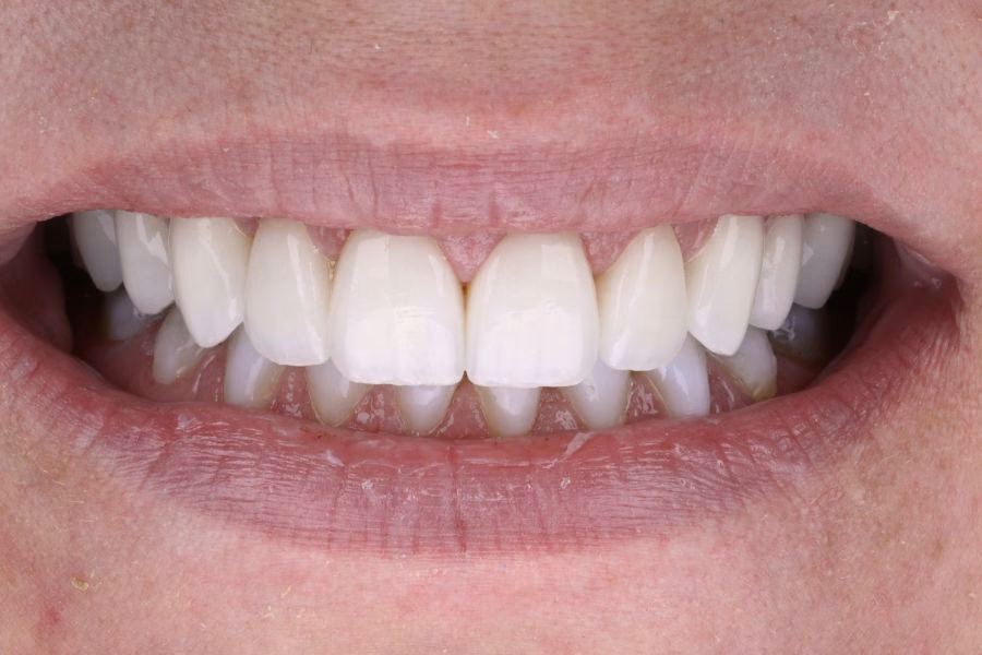 Smile makeover before and after treatment - Flow Dental Studio Gdynia