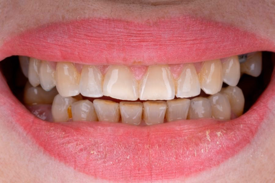 Before & after – Flow Dental Studio Gdynia