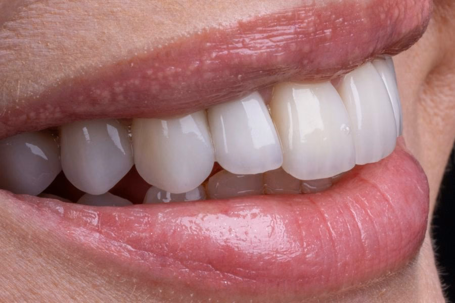 Does teeth whitening hurt?
