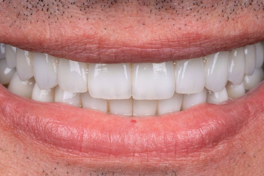 A full, natural smile after replacing missing teeth – Flow Dental Studio Gdynia