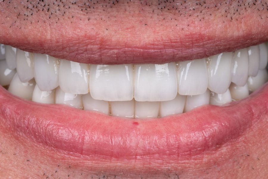Naturalny efekt po wszczepieniu implantu - Flow Dental Studio Gdynia