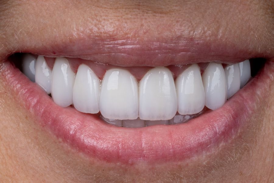 Cyfrowe projektowanie uśmiechu - Flow Dental Studio w Gdyni