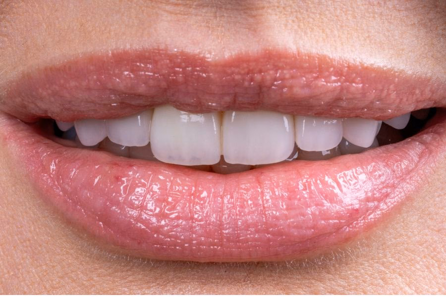 Design of a new smile - 3D model and mock-up