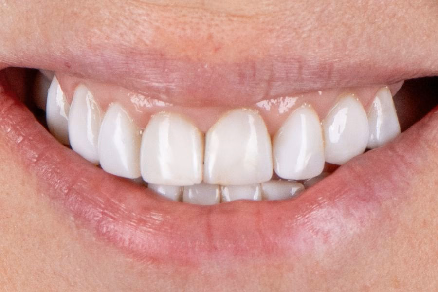 Before the smile makeover