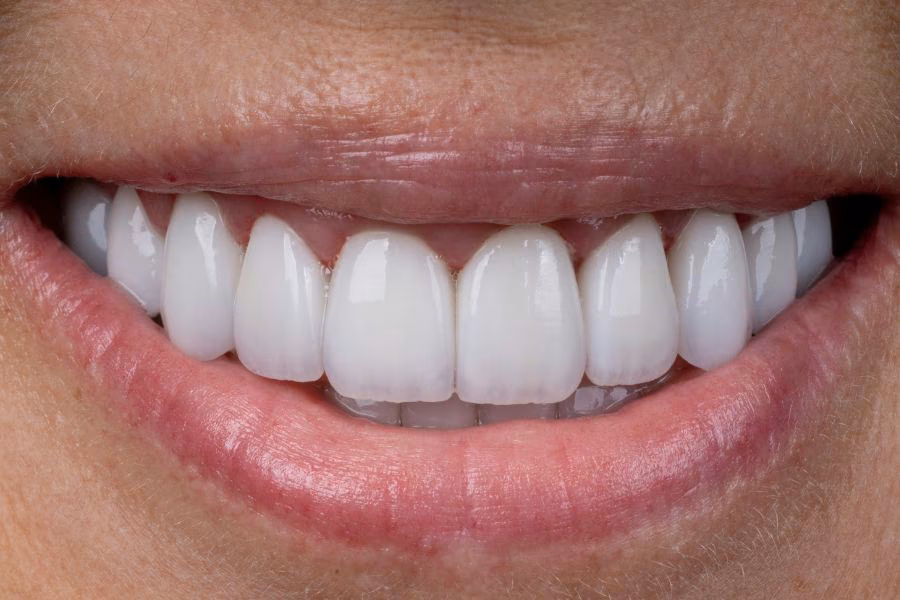 After the smile makeover