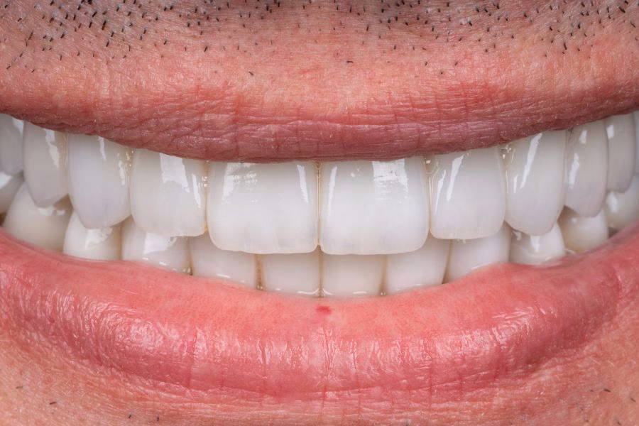 After the smile makeover
