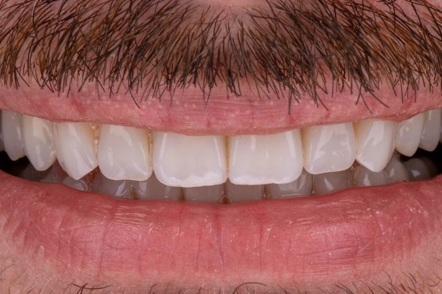Smiles after aligner treatment – photo of a Flow Dental Studio patient in Gdynia