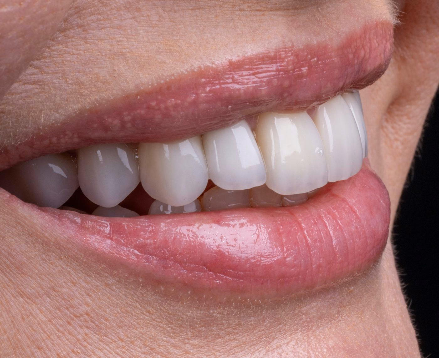 Straight smile after clear aligner treatment Straight smile after clear aligner treatment