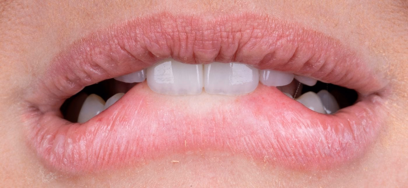 Smiles after aligner treatment – photo of a Flow Dental Studio patient in Gdynia
