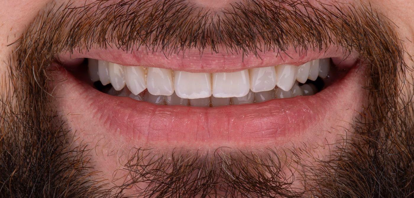 Clear aligners and bonding – photo of a Flow Dental Studio patient in Gdynia