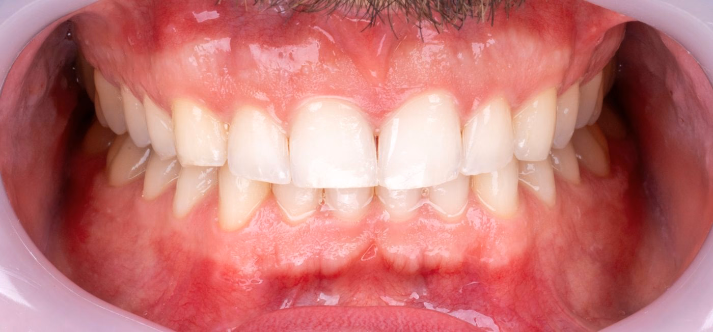 Clear aligners, upper veneers, lower bonding – photo of a Flow Dental Studio patient in Gdynia